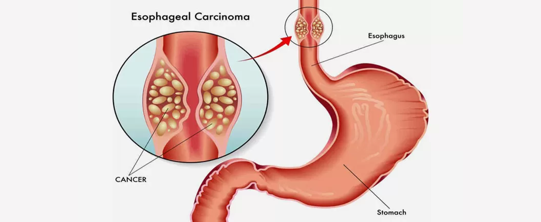 Pancreatic Cancer