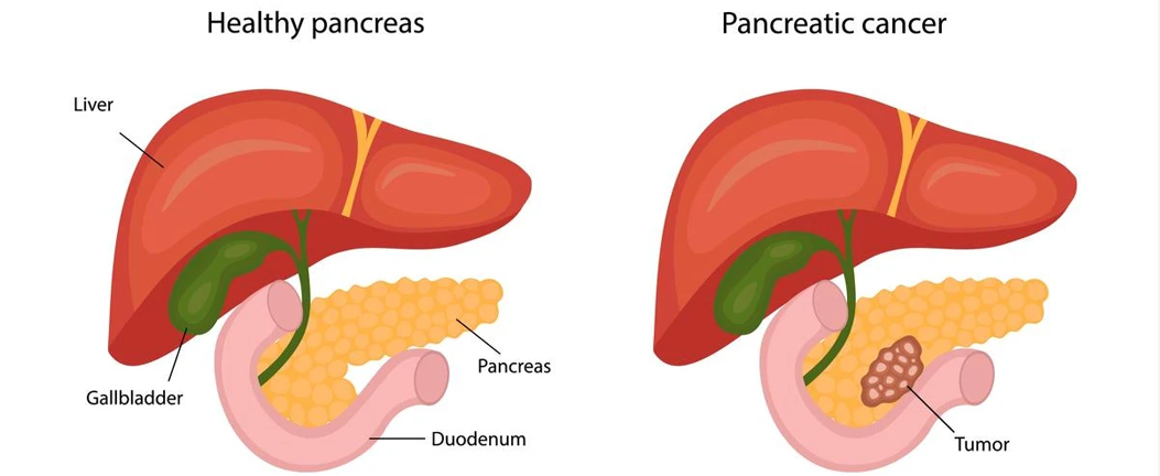 Pancreatic Cancer