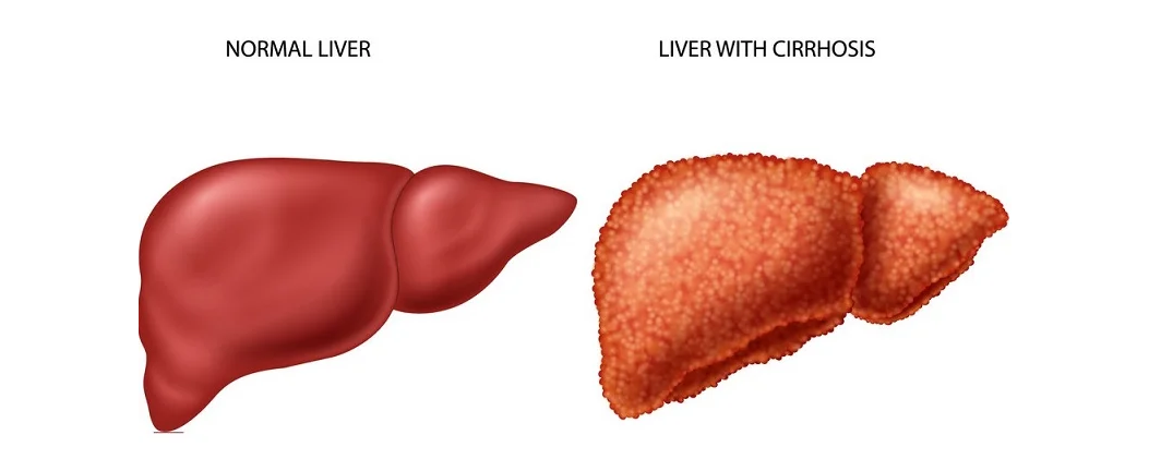 Cirrhosis of Liver