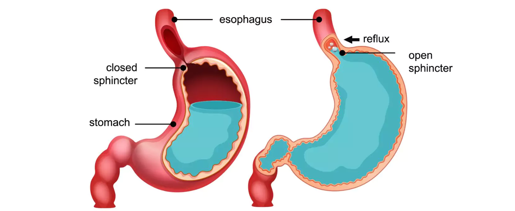 GERD Reflux