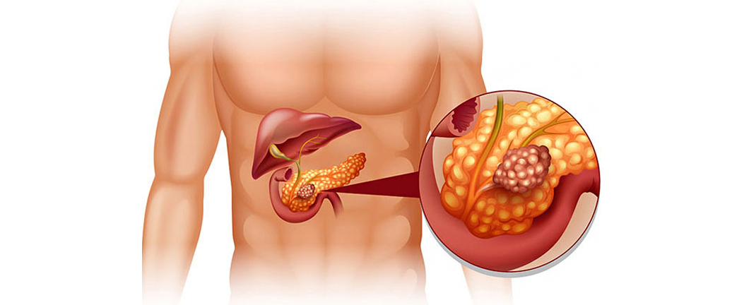 Pancreatitis
